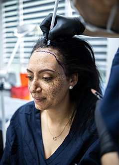 female-hair-transplant